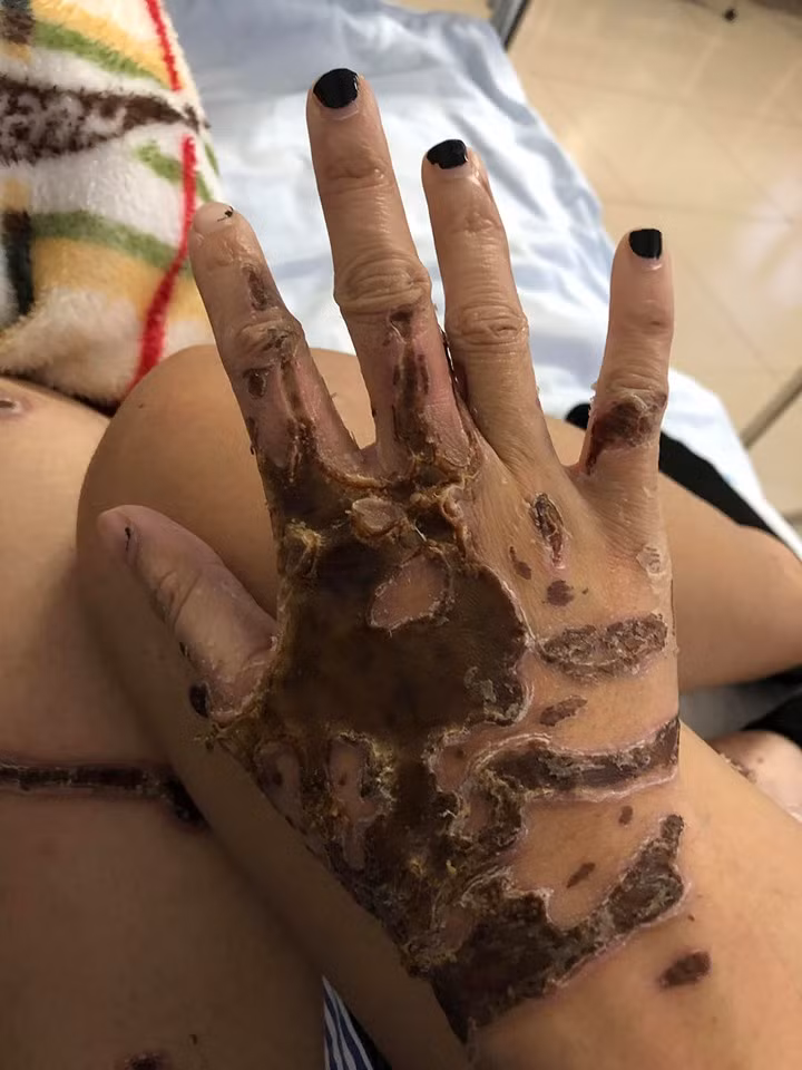 Bàn tay của Lan Vy bị hủy hoại bởi ca axit từ người chồng tương lai là Hải nguyên thiếu úy thuộc lực lượng Cảnh sát PCCC, Công an Đà Nẵng.