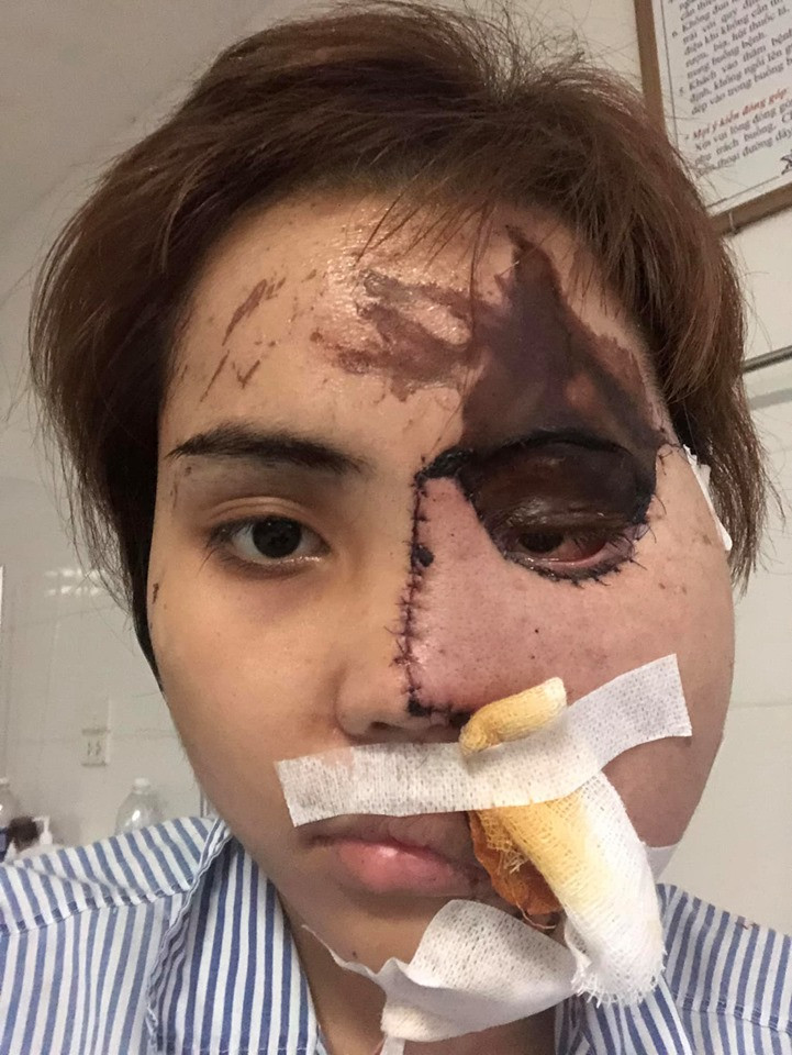 Trong 6 tháng điều trị tích cực tại 1 bệnh viện ở Hà Nội, cô gái bị chồng sắp cưới tạt axit đã phải trải qua 10 cuộc phẫu thuật nhưng vẫn chưa hoàn toàn lành lặn.