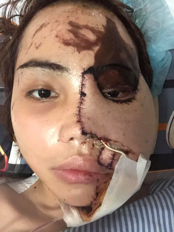 Hiện tại, khuôn mặt của Lan Vy vẫn bị biến dạng nặng nề do bị bỏng axit.