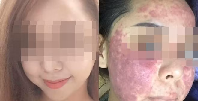 Hậu quả của việc sử dụng mỹ phẩm không rõ nguồn gốc xuất xứ đã được báo chí nói tới rất nhiều trong thời gian qua. Nhưng vì một phần ham rẻ và những chiêu thức quảng cáo quá tinh vi và ngon ngọt của những kẻ bán hàng "không có tâm" vẫn khiến nhiều chị em phải nhận hậu quả khôn lường.