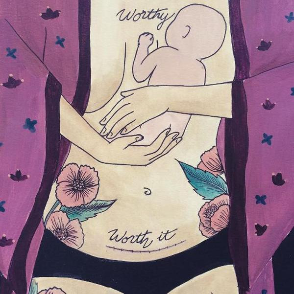 Với nhiều bà mẹ đẻ mổ sẽ để lại những vết sẹo "xấu xí" suốt cuộc đời. Bởi sinh con theo hình thức mổ là một ca đại phẫu cực kỳ đau đớn, mất sức và những tháng ngày phục hồi. Nói một cách đơn giản thì sinh mổ không hề dễ dàng.