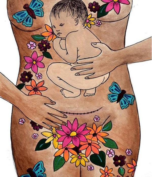 Bộ ảnh “vinh danh” các bà mẹ sinh mổ lay động cộng đồng mạng Bo anh “vinh danh” cac ba me sinh mo lay dong cong dong mang