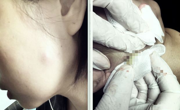 Chat doc trong mui tiem botox lam dep “cung ho” Botulinum trong Pate Minh Chay