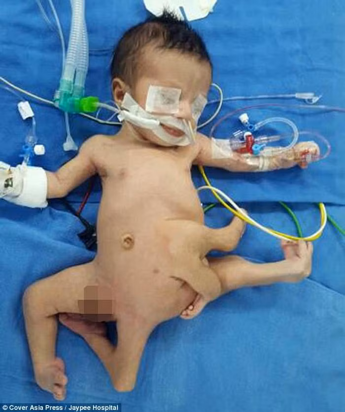 Chứng polymelia có thể xuất hiện khi phôi thai phát triển thành cặp song sinh dính liền nhau rồi một trong 2 em bé ngừng phát triển, nhưng vẫn tiếp tục phát triển các tay chân hay cơ quan trên cơ thể của em bé còn lại.