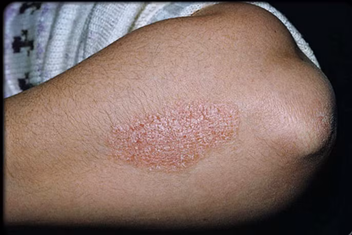 10. Chữa trị bệnh ngoài da như bệnh vẩy nến, eczema và bệnh ung thư thậm chí nước tiểu là mát xa trên da. Ảnh: chuyenkhoadalieu.net.