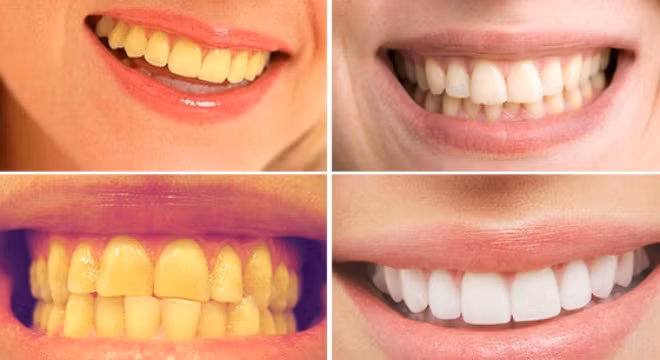 6. Tẩy trắng răng: Thời La Mã cổ đại, người dân sử dụng nước tiểu nhằm tẩy trắng răng, dựa vào việc ammoniac - thành phần chính có trong nước tiểu - là một chất tẩy khá mạnh. Ảnh: thuockidieu.com.