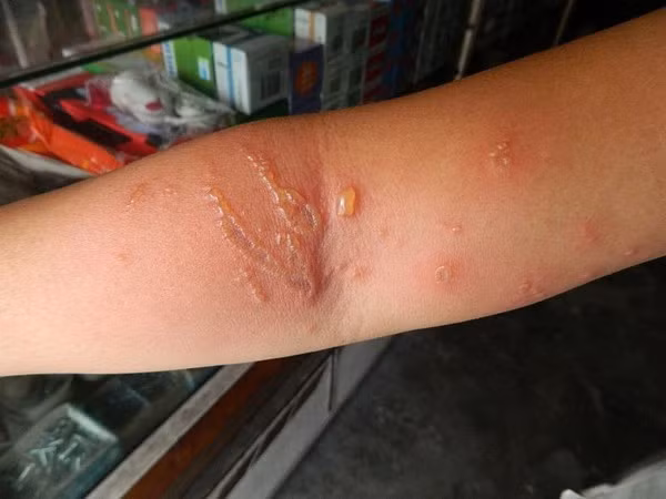 13. Chữa bệnh do bị con sứa chích. Lấy nước tiểu của chính mình nhỏ vào vết thương đó, tình trạng sưng ngứa sẽ hết. Ảnh: tapchimeovat.com.