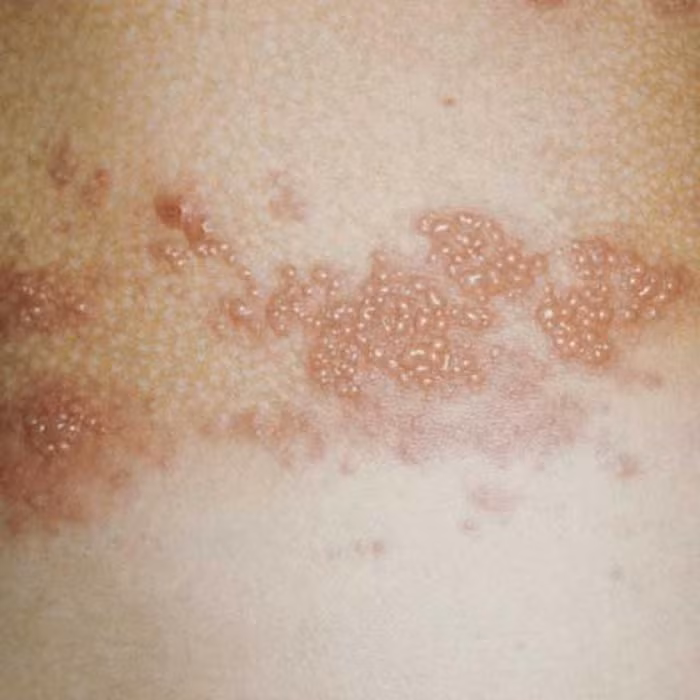 Trị giời leo. Giời leo là bệnh do cơ thể quá nóng cộng với vi khuẩn trong nước tiểu của sinh vật gây nên. Có thể dùng bài thuốc từ tro bếp để chữa bệnh này. Hốt ít tro, sàng sạch sau đó cho rượu vào trộn đều tạo thành hỗ hợp sền sệt. Sau đó dùng hỗn hợp này bôi lên da lớp dày khoảng 0,5cm, đợi khoảng 3 tiếng đồng hồ. Tro bếp sau khi đã rút hết nhiệt từ cơ thể sẽ tự khô và rơi ra ngoài. Ảnh: Benhykhoa.