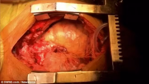 Ky la hai trai tim chung nhip dap trong cung mot co the