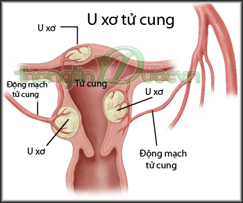 U xơ tử cung. Là loại bệnh cực kỳ phổ biến ở nữ, tỷ lệ phụ nữ trên 35 mắc u xơ tử cung chiếm đến gần 50%, và phụ nữ trên 50 còn cao hơn, 75%. Tuy nhiên, chị em lại rất ít người phát hiện bệnh bởi triệu chứng thường bị nhầm lẫn với các bệnh khác. Ảnh: Yduocvietnam.