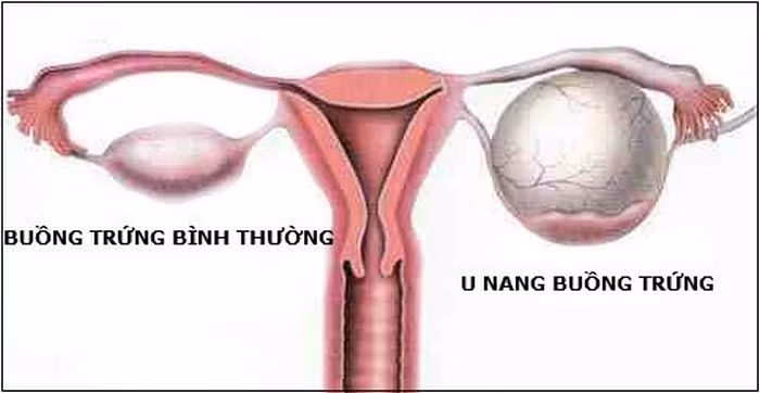 U nang buồng trứng. Được xác định là u lành tính, nhưng nếu không phát hiện sớm, nó có thể gây ra nhiều biến chứng nguy hiểm. Bệnh có biểu hiện ban đầu là những cơn chuột rút trong kỳ kinh nguyệt. Ảnh: Yduocvietnam.