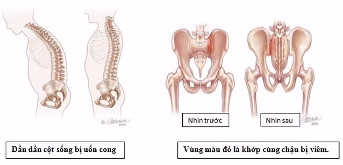 Bệnh viêm vùng chậu. Là bệnh nhiễm trùng tử cung, buồng trứng hoặc ống dẫn trứng. Cơn đau của bệnh này rất nhẹ, không rõ ràng nhưng cũng khiến cho bạn không thoải mái. Ảnh: Chyuenkhoaxuongkhop.
