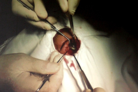 Viên đạn hoặc mảnh kim khí nằm trong da thịt không lấy ra được: Bọ ngựa một con, bã đậu nửa hạt, hai thứ giã nát. Đắp hỗn hợp trên vào miệng vết thương, sau khi lấy được dị vật dùng nước sắc hoàng liên ngâm rửa vết thương. Ảnh: dantri.com.vn. (Thông tin trong bài chỉ mang tính chất tham khảo, trước khi sử dụng bài thuốc, vui lòng hỏi ý kiến bác sĩ).