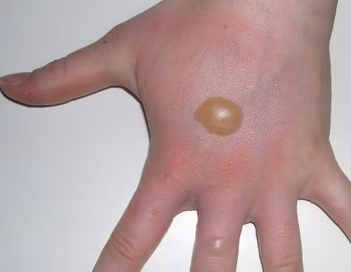 7. Điều trị bỏng và vết thương nhỏ: Trong thời cổ đại, hỗn hợp lá dâu da xoan và mật ong còn được dùng để chữa lành những vết cắt nhỏ ngoài da hoặc các vết bỏng nhẹ. Do cả 2 dược liệu này để có tác dụng chống viêm có trong thành phần rất hiệu quả. Ảnh: chuyenkhoadalieu.net. (Thông tin trong bài chỉ mang tính chất tham khảo, trước khi sử dụng bài thuốc, vui lòng hỏi ý kiến bác sĩ).