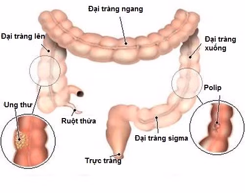 Do ung thư trực tràng: Đây là loại bệnh lý thường gặp ở những người cao tuổi. Những người mắc ung thư trực tràng sẽ có máu tươi chảy theo từng giọt hoặc tia khi đại tiện, hiện tượng chảy máu thường xảy ra trong khoảng một thời gian dài. Ảnh: VietQ.vn.