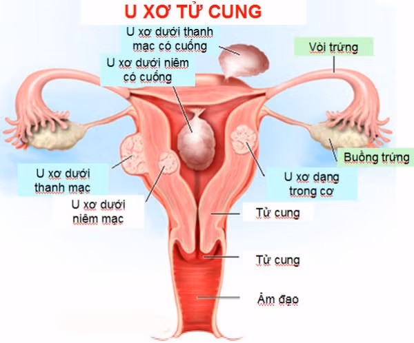 Hoặc cũng có thể do viêm nhiễm nấm hoặc các bệnh như: U xơ tử cung: u xơ dưới niêm mạc, dị dạng tử cung, lao sinh dục, có các khối u nội tiết của buồng trứng. Ảnh: chuauxotucung.net.