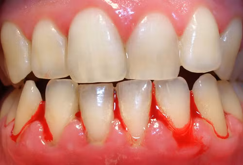 3. Chảy máu chân răng. Do bệnh tiểu đường: Căn bệnh về chuyển hóa liên quan đến mức độ sản xuất, hấp thụ đường và insulin trong máu. Nếu không chữa trị, bệnh tiểu đường có thể dẫn đến các vấn đề sức khỏe nghiêm trọng.