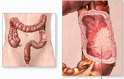 Do viêm loét đại trực tràng: Người bị mắc bệnh viêm loét đại trực tràng hiện tượng đi ngoài ra máu và có các biểu hiện khác như đau bụng và một số người còn thấy có cả chất nhầy lẫn trong phân. Ảnh: Daitrang.vn.