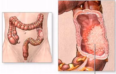 Do viêm loét đại trực tràng: Người bị mắc bệnh viêm loét đại trực tràng hiện tượng đi ngoài ra máu và có các biểu hiện khác như đau bụng và một số người còn thấy có cả chất nhầy lẫn trong phân. Ảnh: Daitrang.vn.