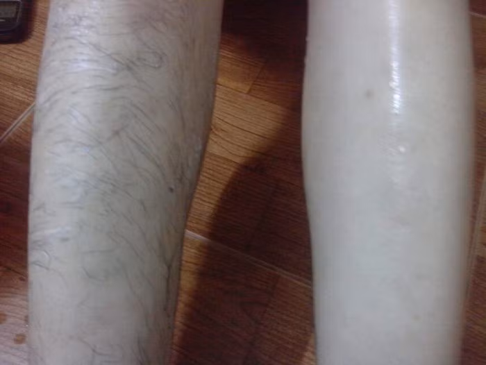 Ngoài ra, họ còn có phương thuốc tẩy lông rất độc đáo là lấy phân mèo, phơi khô và trộn với bột, đun lên cùng dấm, sau đó rửa lên chỗ cần cạo lông. Tuy nhiên, những bài thuốc này vẫn chưa ai kiểm chứng về hiệu quả của nó. Ảnh: Kazuhashop. (Thông tin trong bài viết chỉ mang tính chất tham khảo. Trước khi sử dụng bài thuốc, bạn vui lòng hỏi ý kiến bác sĩ).