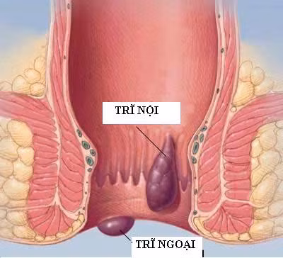 7. Giúp thanh nhiệt, săn chắc cơ, thích dụng cho các chứng trĩ, sa trực tràng, sa dạ con: Lá dâu 16 - 18g sắc, đợi nước còn nóng ấm rửa búi trĩ, trực tràng… và đẩy lên, lấy băng băng lại, nằm nghỉ. Ảnh: duocphamvinhgia.vn.