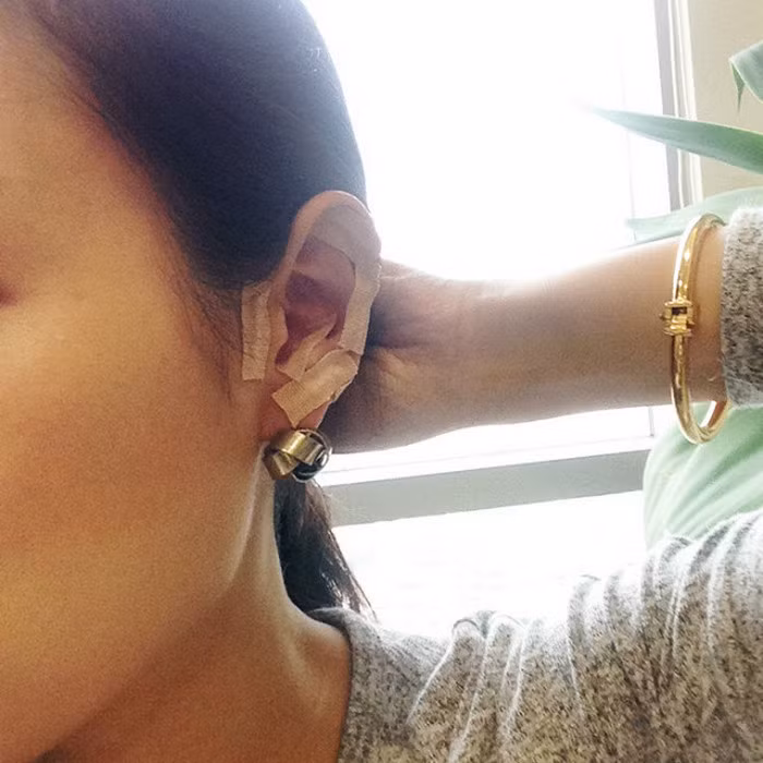 Sau đó, bác sỹ sẽ dán vài miếng băng gạc nhỏ có chứa chất hóa học geramanium vào vành tai giúp cơ thể giảm căng thẳng. Kế tiếp là massage gò má để các cơ được thả lỏng nhằm mục đích xương sẽ về vị trí ban đầu dễ hơn.