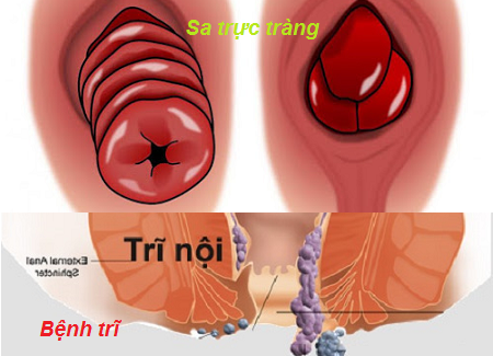 Trĩ, sa trực tràng: Lấy một lượng nước sắc hạt tiêu đen rồi thêm gấp 1,5 lần bột hạt carum (hạt dùng làm gia vị tăng mùi vị cho bánh mì, bánh ngọt) và 7,5 lần mật ong để dùng. Ảnh: benhvienk.com.