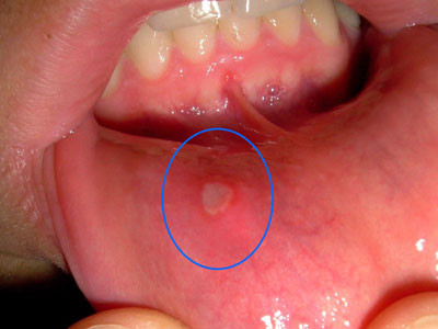 7. Chữa lợi và niêm mạc lở loét, lưỡi rộp: Vỏ ốc 2 cái, cỏ nhọ nồi 50g. Vỏ ốc sao với cát, tán mịn; cỏ nhọ nồi sấy khô, tán bột. Trộn đều hai thứ bột. Xát vào răng lợi nhiều lần trong ngày. Ảnh: yhoccongdong.com.