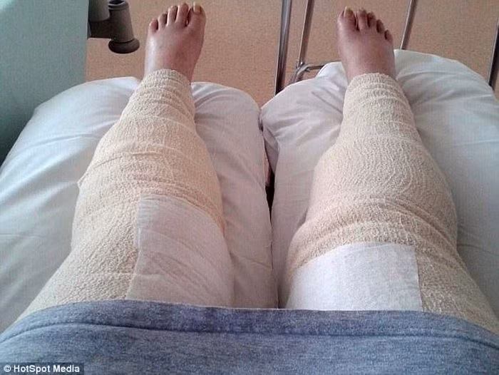 Tuy nhiên, cô sẽ phải phẫu thuật 21 lần nữa để có thể cải thiện làn da của mình và thực hiện các phương pháp vật lý trị liệu để có thể tự đi lại được bằng nạng.