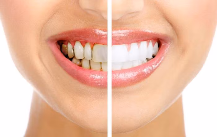 Làm trắng răng. Những người có hàm răng xỉn màu, khi tiếp xúc với gỗ sưa 100 tuổi trở lên răng có thể trắng trở lại. Ảnh: Nhakhoavietuc.