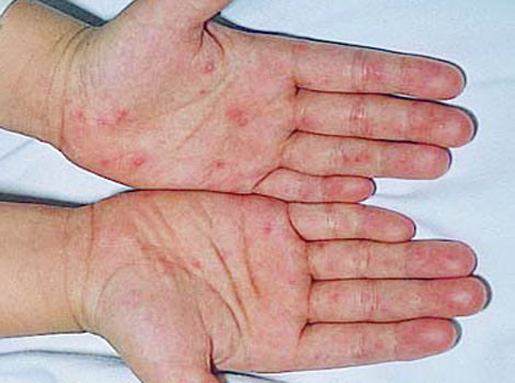 2. Viêm loét: Lấy lá bàng non, số lượng lá tùy vào vết thương nhiều hay ít. Cho lá bàng vào nồi, đun sôi rồi để lửa nhỏ khoảng nửa giờ. Ngâm vết loét vào nước lá ấm. Sau khi ngâm thấm bằng khăn sạch hoặc để tự khô rồi bôi thuốc cần thiết tùy vào bệnh. Ảnh: benhvirus.com.