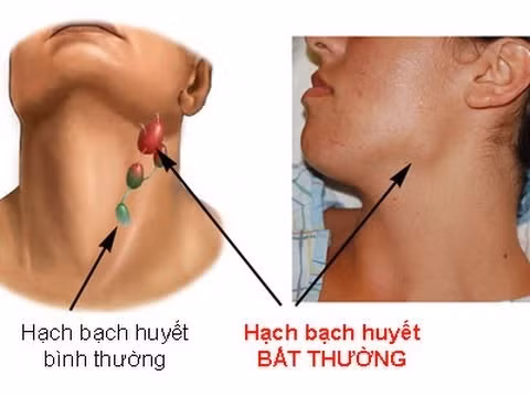 Tiếp tục đun sôi thêm khoảng 5 phút nữa, rót lấy nước, để vừa nguội thì uống ngay. Không nên uống khi nước đã chuyển sang màu đỏ. Mỗi ngày uống 2 lần, trước bữa ăn khoảng 30 phút. Uống liên tục trong một vài tuần sẽ khỏi. Ảnh: YouTube.com.