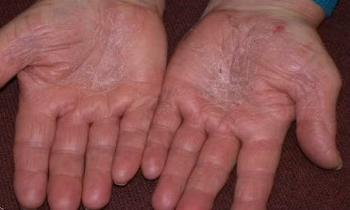 Hiện nay bệnh á sừng không chỉ điều trị bằng thuốc tây mà còn có thể chữa được bằng những bài thuốc dân gian được truyền theo kinh nghiệm của những người đã dùng. Sau đây là 7 bài thuốc dân gian rất "linh nghiệm" được ứng dụng để hỗ trợ việc điều trị bệnh á sừng. Ảnh: chuyenkhoadalieu.net.