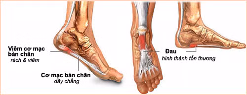 Chữa viêm cơ (bắp chuối): Sài đất tươi 50g, bồ công anh 20g, kim ngân hoa 20g, cam thảo đất 16g. Sắc uống ngày một thang. Kết hợp với sài đất tươi, giã nát, đắp tại chỗ nơi bị sưng đau. Ảnh: coxuongkhop.info.