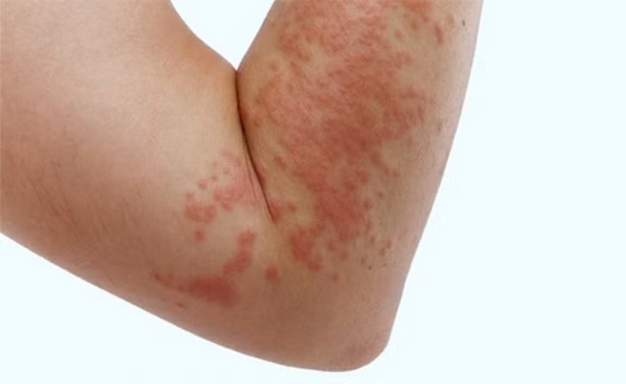 Mề đay. Nếu mề đay nốt đỏ thì dùng hoa màu đỏ, nốt trắng thì dùng hoa màu trắng sắc nước uống và ngâm rửa. Hoặc dùng hoa mào gà và cây thương nhĩ thảo (tỷ lệ 1:1) sắc lấy nước ngâm rửa. Ảnh: Voh.