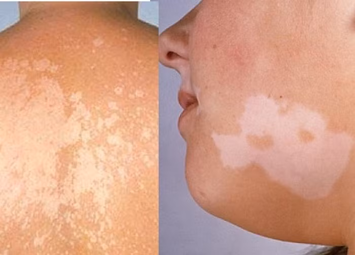 Trị lang ben. Lấy 50g cây tơ hồng tươi thái nhỏ ngâm trong 100ml rượu cồn 75 độ trong 7 ngày. Khi dùng, lấy tăm bông nhúng vào thuốc bôi vào chỗ bệnh. Mỗi ngày bôi từ 2 đến 3 lần, dùng liên tiếp 30 ngày. Ảnh: Ehospital.