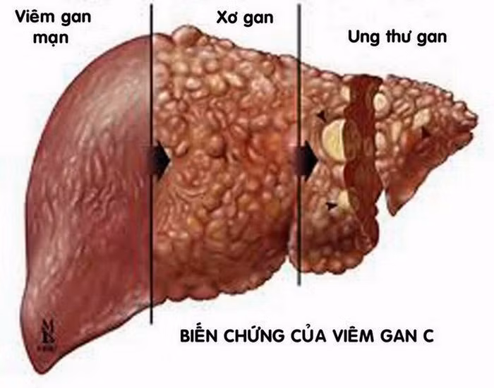 Điều trị viêm gan mãn tính. Dùng 15-30g tầm gửi cây gạo kết hợp đan sâm, ngũ vị tử, bạch thược, huyền hồ sách, câu kỳ tử, thảo quyết minh, sinh địa. Tất cả những vị thuốc này sắc uống trong ngày. Ảnh: Thuocdieutrigan.