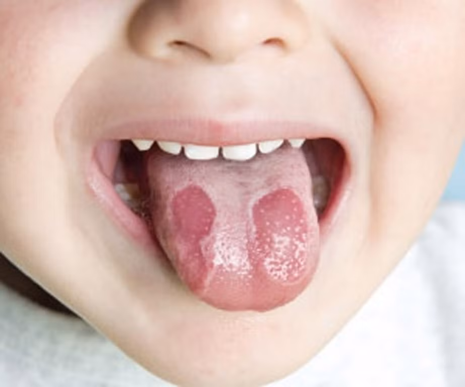 2. Viêm lưỡi bản đồ: Trên lưng lưỡi xuất hiện những viền màu trắng phía trong có màu đỏ sậm hơn màu lưỡi bình thường làm mất gai lưỡi. Lúc đầu là một vết nhỏ sau đó lan rộng ra, đôi khi có nhiều vết trên lưỡi. Ảnh: tuanbaovannghetphcm.vn.