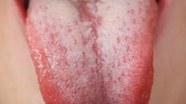 3. Lưỡi trắng: Thi thoảng bạn có thể thấy lưỡi sẽ xuất hiện những đốm trắng. Nguyên nhân là do những mảnh vụn thức ăn, những tế bào chết và vi khuẩn đang đang bị mắc kẹt trên lưỡi. Ảnh: soha.vn.