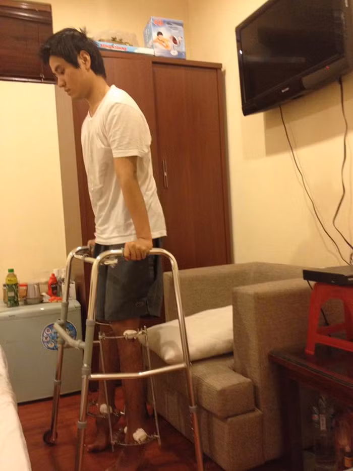 Kéo dài chân. Chàng trai Hoàng Tùng Anh (SN 1993) cũng đã gây chú ý cộng đồng mạng khi chia sẻ câu chuyện kéo chân của mình vào năm 2012. Chàng trai chỉ cao 1m67 đã quyết định kéo dài chân lên 1m76 tại một bệnh viện ở Hà Nội. Ảnh: Tiin.