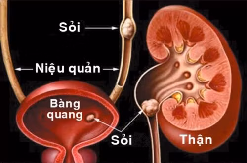 Chữa sỏi thận, sỏi bàng quang: Dùng cây cỏ bợ dạng tươi đem rửa thật sạch, giã nát rồi vắt lấy nước cốt dùng để uống vào mỗi buổi sáng. Mỗi ngày người bệnh cần uống 1 bát như vậy và uống liên tục trong một liệu trình khoảng 5 ngày sẽ có tác dụng rất tốt. Ảnh: phongkhamauviet.vn.