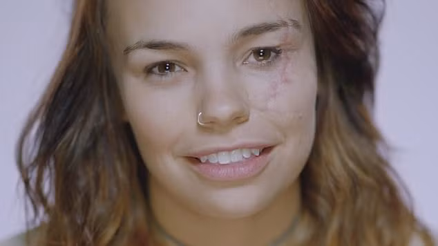 Cô Phyll, 23 tuổi. Cô đã có những vết sẹo trên khuôn mặt sau khi bị thương trong một tai nạn xe buýt trong khi đi làm tình nguyện. Chiếc xe chở tình nguyện viên đã va phải một chiếc xe buýt khác.