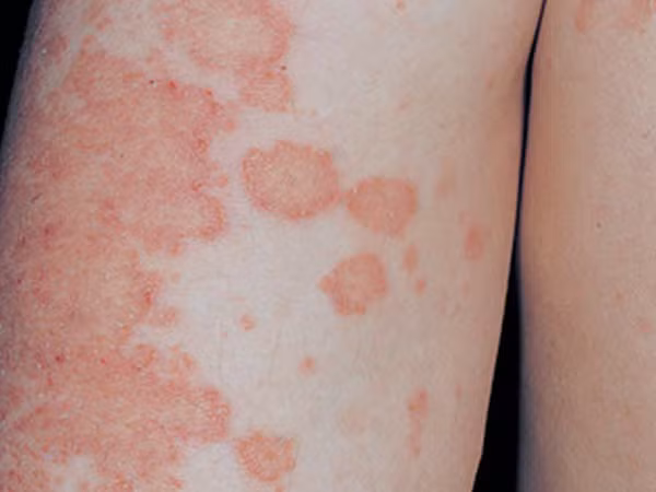 Hóa lành các vết sẹo hiệu quả, giảm các triệu chứng chóc lở eczema, ngứa ngoài da. Ảnh: kenh14.vn.