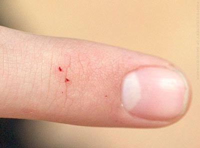 Đắp lên các vết thương bị nhiễm độc, vết xây xước nhẹ. Đặc biệt dùng để giải độc những vết bị nhện cắn, côn trùng cắn. Ảnh: alobacsi.com.