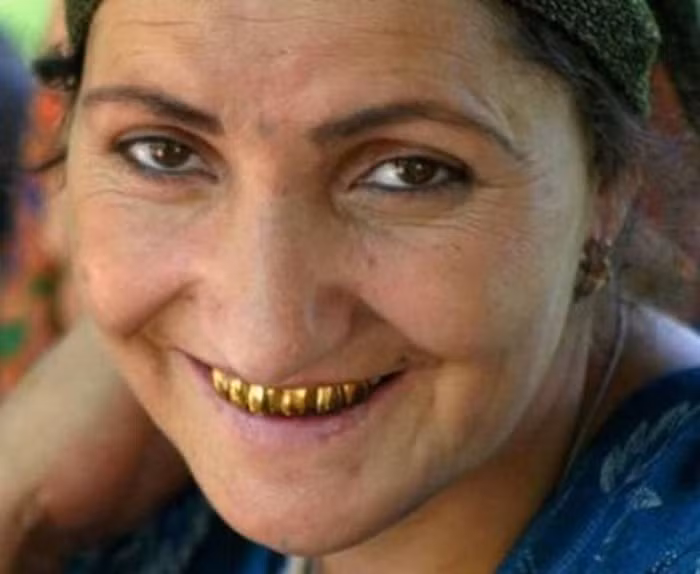 1. Vàng. Liệu pháp chữa bệnh từ kim loại này đã được sử dụng trong nha khoa gần 3000 năm trước. Trong cuốn sách đầu tiên được xuất bản về nha khoa do Artnet Buchlein ra đời năm 1530 đã ghi chép lại rằng, các nha sĩ đã chữa bệnh sâu răng và các bệnh ở răng bằng vàng lá. Chắc chắn rằng nó không có hại cho nên bây giờ vàng vẫn được dùng để nạm, trám răng. Ảnh: Vietbao.