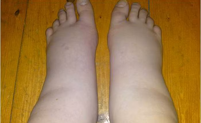 Phù thũng là loại bệnh do cơ thể bị tích tụ quá nhiều thể dịch làm cho toàn thân sưng phù. Nguyên nhân là do chức năng của tỳ, phế, thận mất cân bằng. Bệnh này ngoài việc châm cứu, có thể dùng các loại đậu chữa bệnh phù thũng như sau. Ảnh: Skxanh.