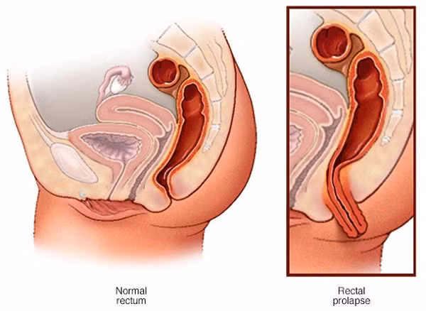 Tốt cho người bị trĩ, sa dạ con: Người phụ nữ mang thai bị trĩ cũng có thể dùng hoa thiên lý để trị bệnh mà không phải lo sợ ảnh hưởng đến thai nhi. Có thể dùng lá thiên lý giã đắp trực tiếp vào chỗ bị trĩ, kết hợp với uống 3 đến 4 bát nước lá thiên lý tươi, hoặc nấu canh ăn trực tiếp. Ảnh:ihph.org.