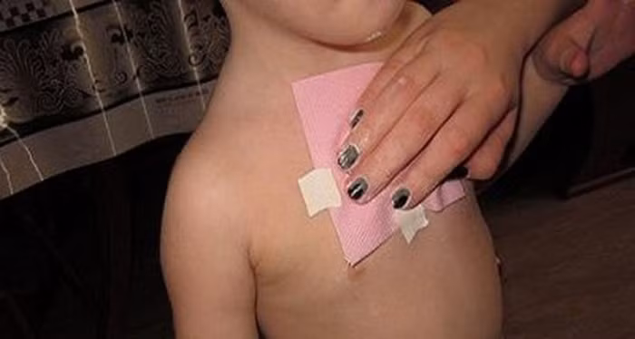 Bỏ hỗn hợp vào khăn sạch mỏng rồi phủ thêm lớp gạc để nó không dính trực tiếp vào da. Đặt hỗn hợp này lên ngực (vùng phổi) và dùng băng keo cố định lại. Tốt nhất nên dán trước khi đi ngủ. Ảnh: Thuockidieu.