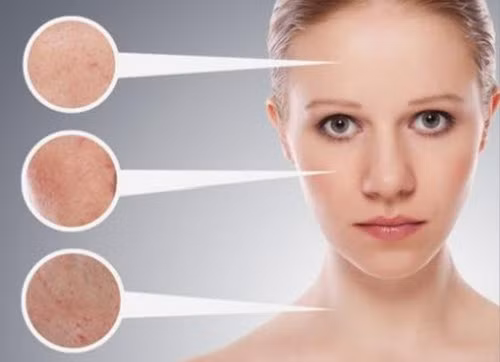 Ức chế tăng tiết nhờn, se nhỏ lỗ chân lông. Ảnh: Cachtrangda.com.