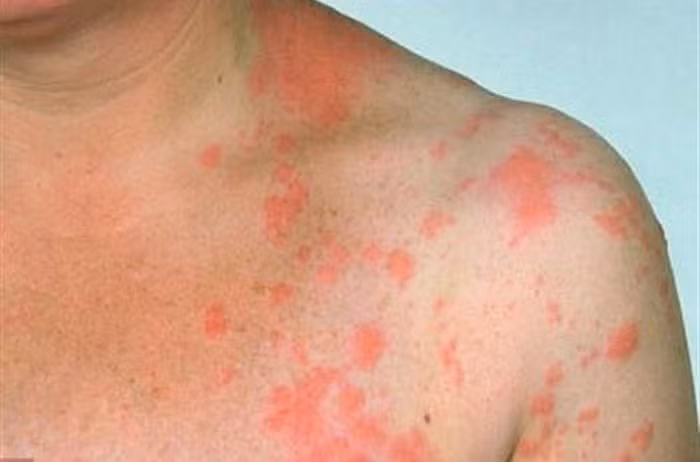 Trị zona và mẩn ngứa. Dùng 40g đơn lá đỏ sao vàng, sắc uống ngày một thang, chia 2-3 lần. Uống nhiều ngày đến khi các triệu chứng thuyên giảm. Có thể uống nhắc lại vài đợt. Ảnh: Benhmedaymanngua.